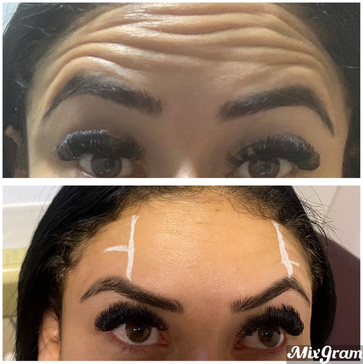 Toxina botulínica — antes e depois na testa