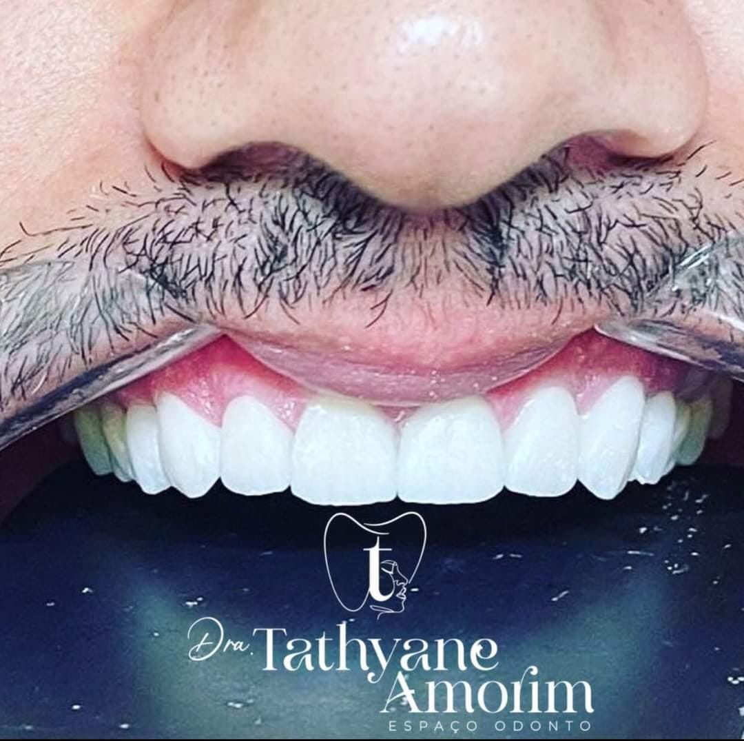 Sorriso com lentes de contato dental