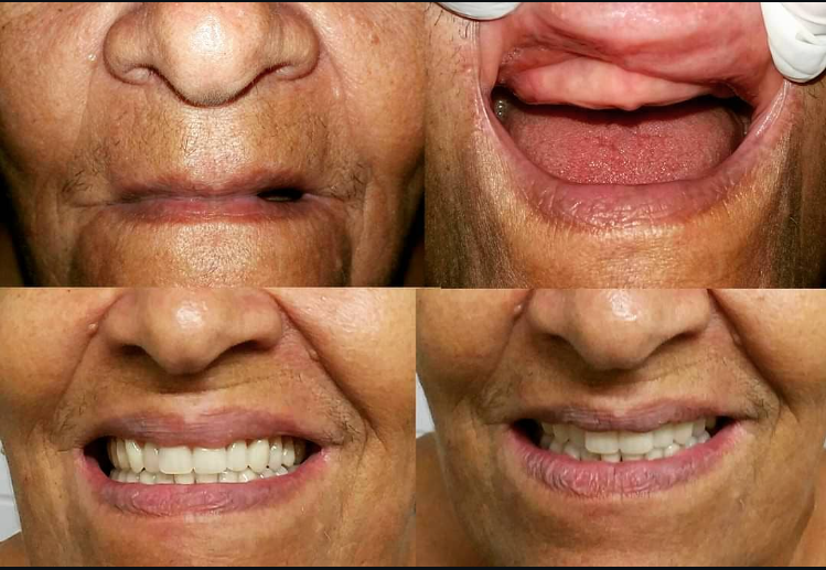 Reabilitação oral completa — antes e depois
